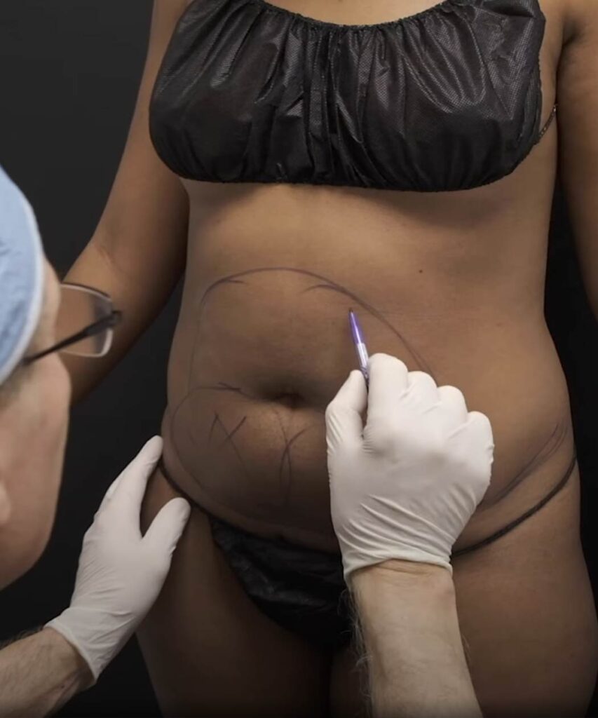 Liposuction in Atlanta, Lipo Procedure